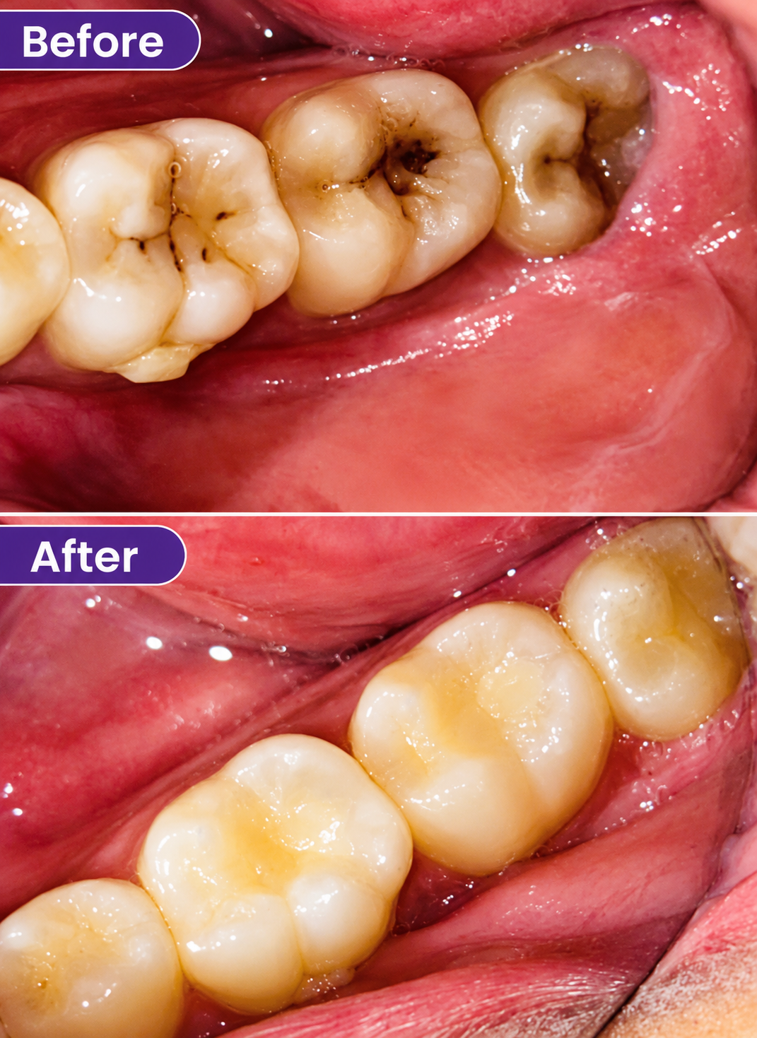 Composite Restoration - slide 2