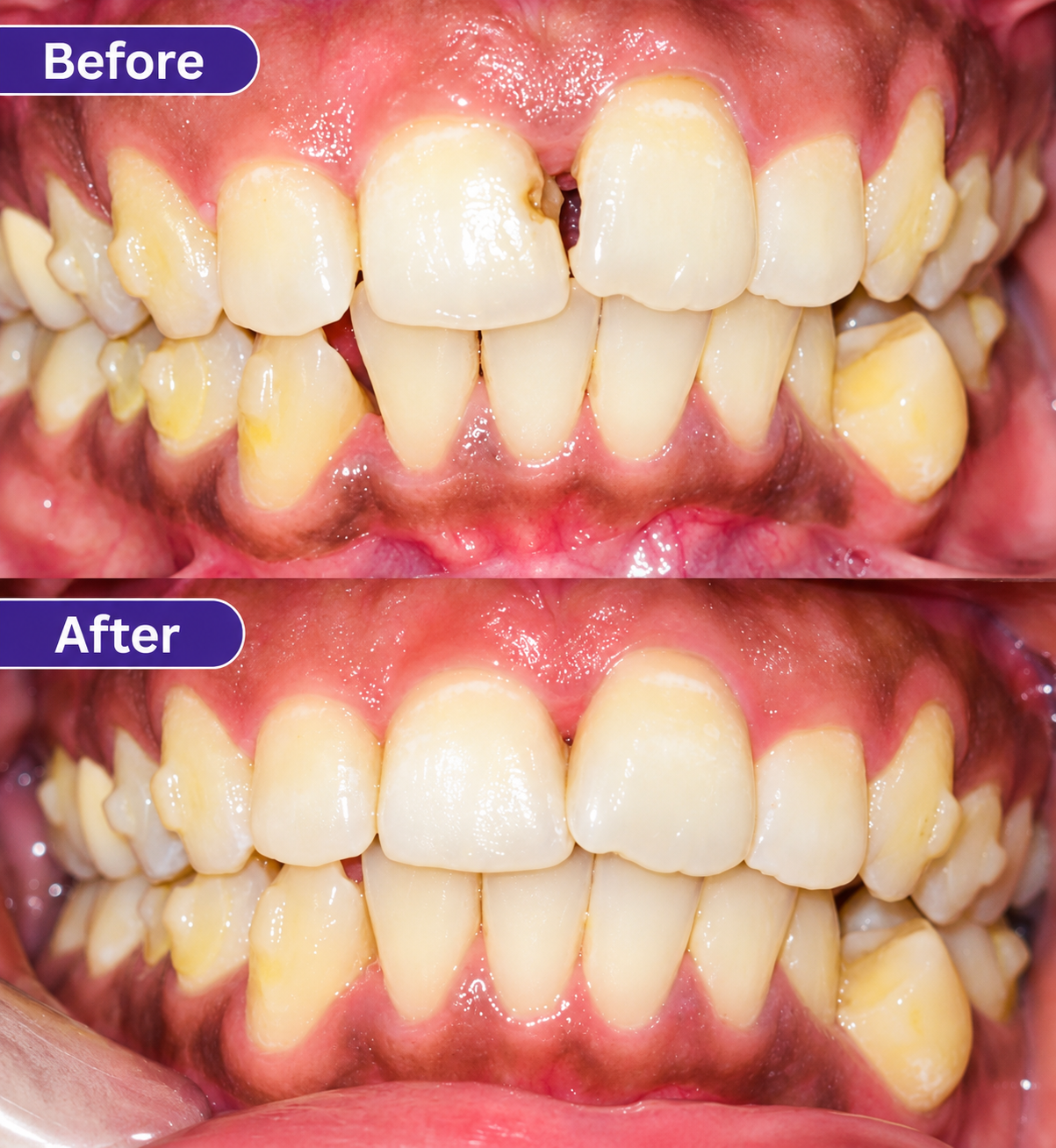 Composite Restoration - slide 1