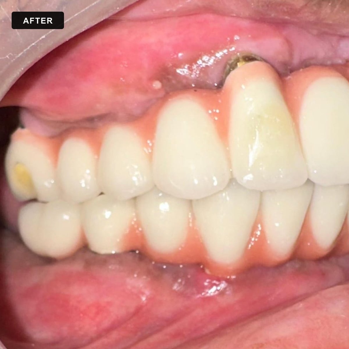 Full Mouth Rehab