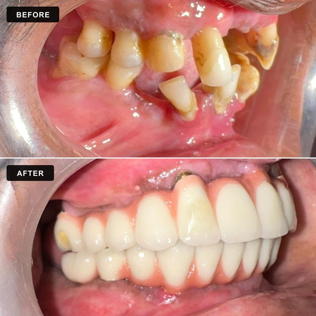 Full Mouth Rehab