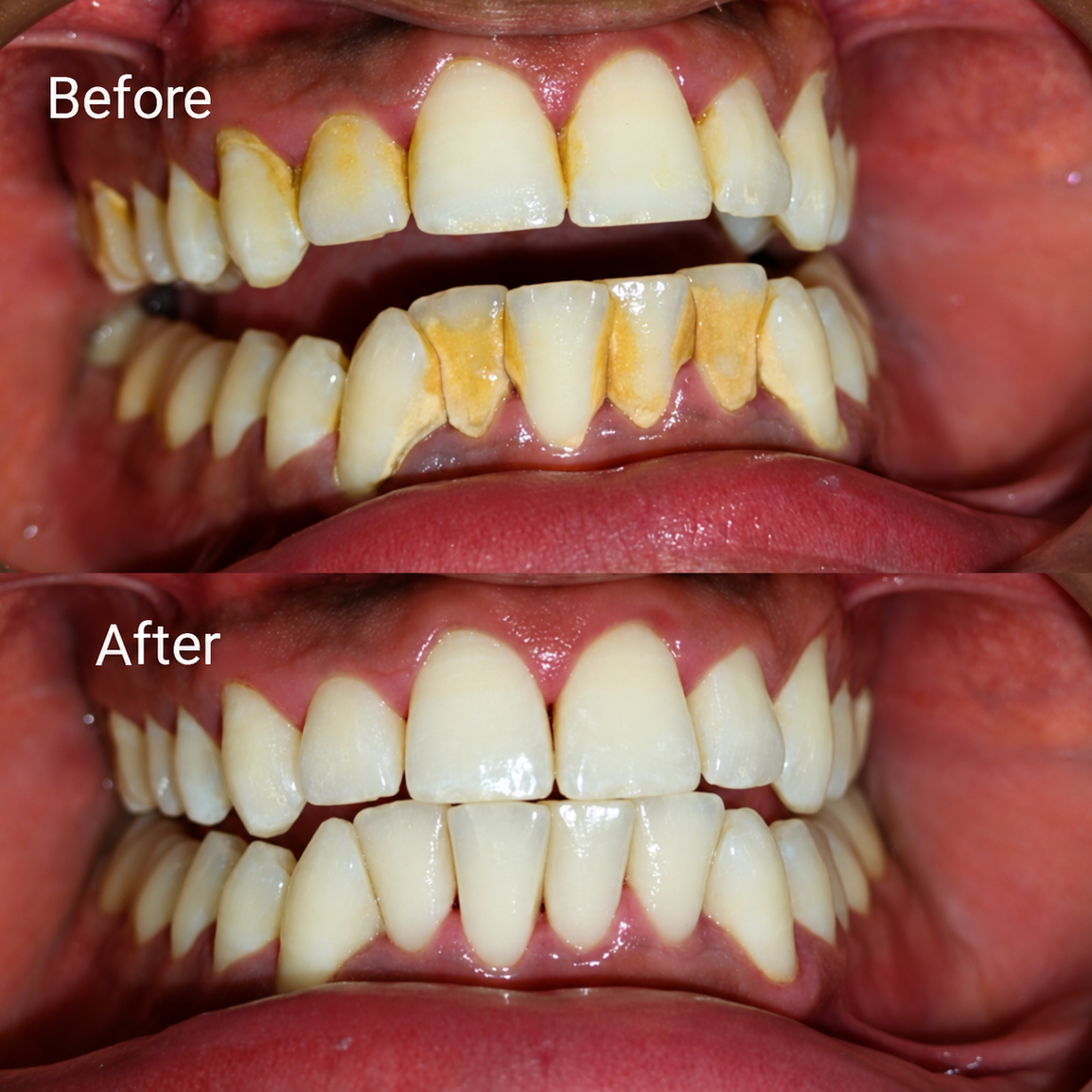 Full Mouth Scaling - slide 1