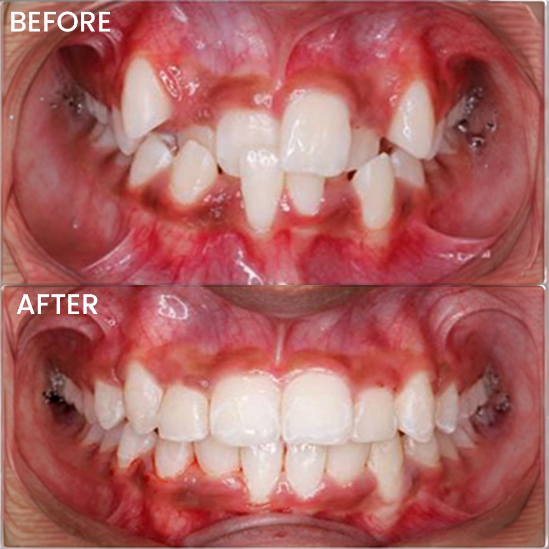 Teeth Alignments