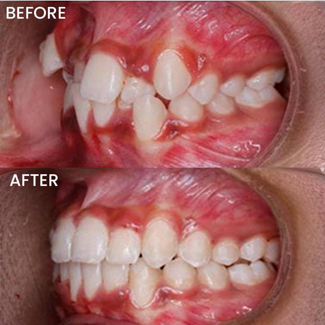 Teeth Alignments