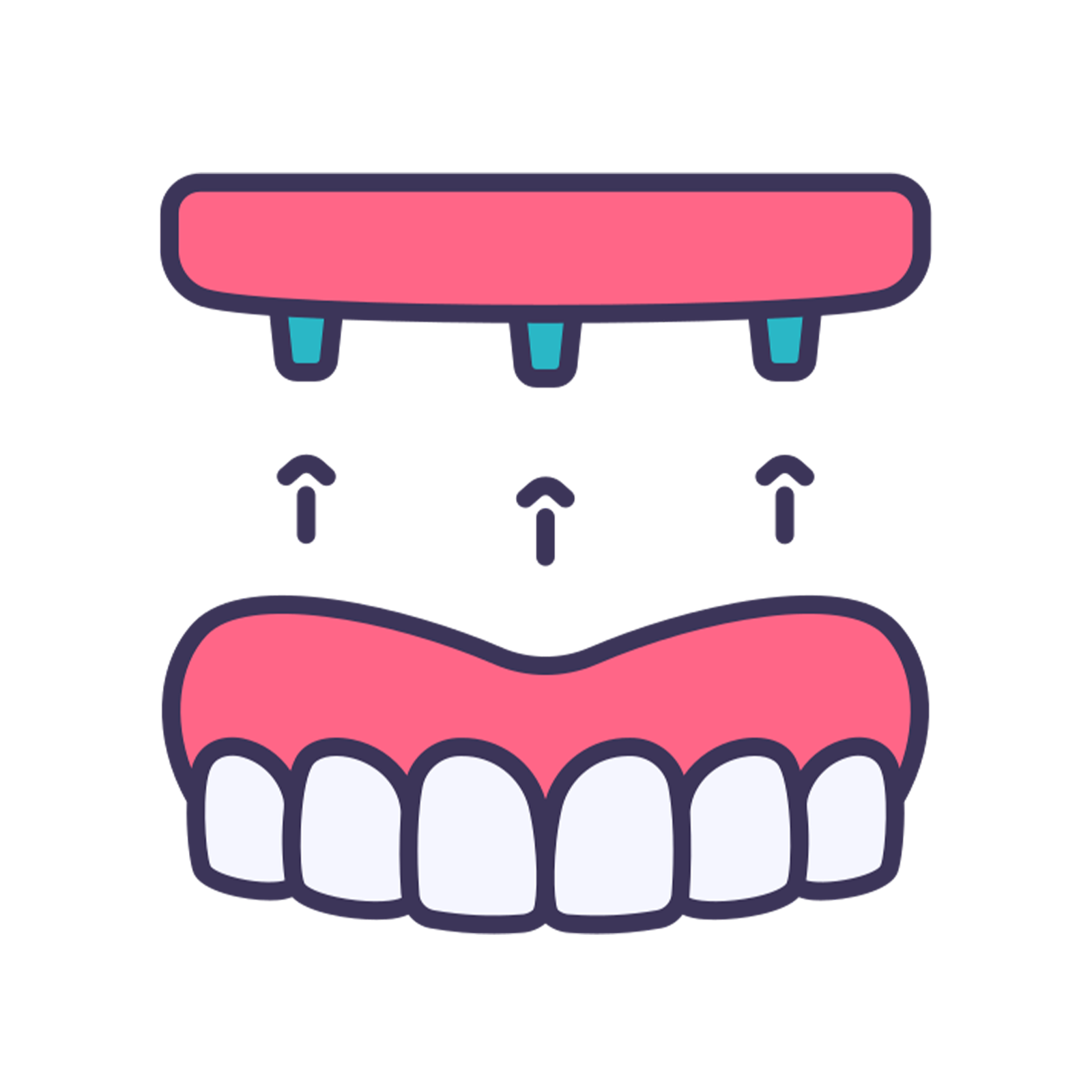 Implant-Supported Dentures