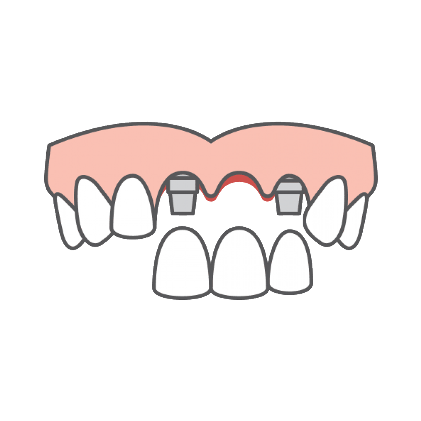 Implant-Supported Dentures